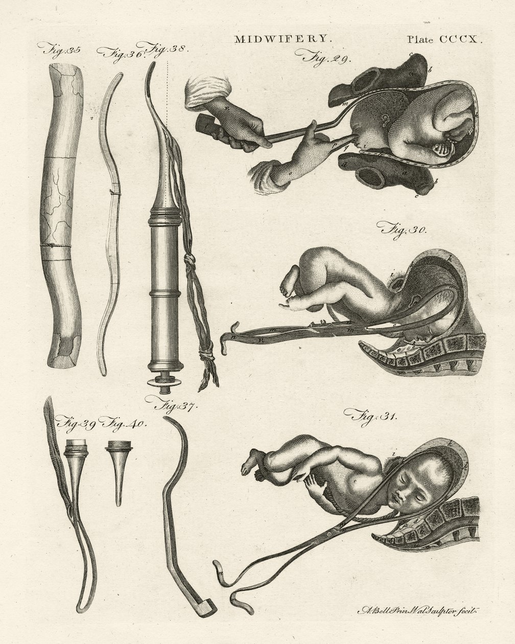 Geburtshilfe, Illustration aus 