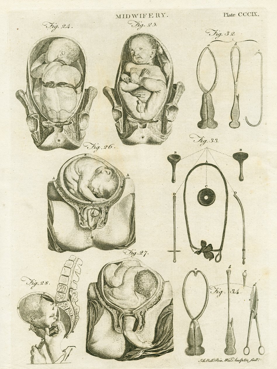 Geburtshilfe, Illustration aus 