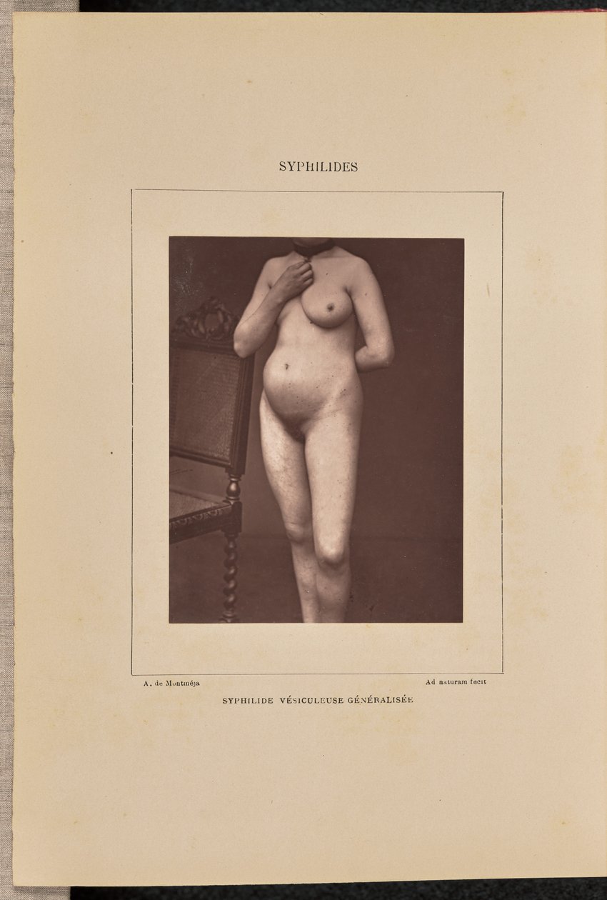 Generalisierte vesikulöse Syphilis von Arthur de Montmeja