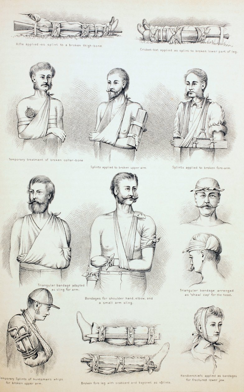 Vorübergehende Behandlung von Frakturen, um 1890 von English School