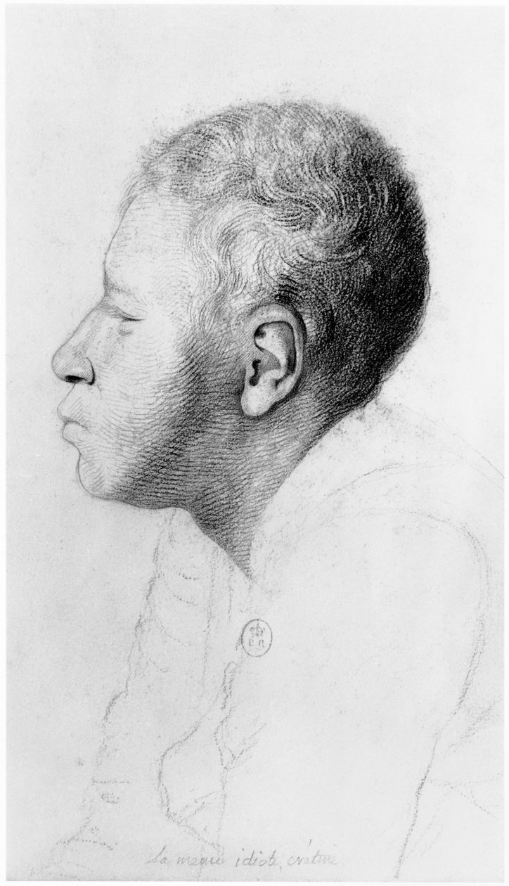 Kretin, Profil, Illustration aus einem unveröffentlichten Traktat von Jean Etienne Dominique Esquirol (1772-1840) über die Geisteskranken des Salpetriere-Asyls, ca. 1818 von Georges Francois Gabriel
