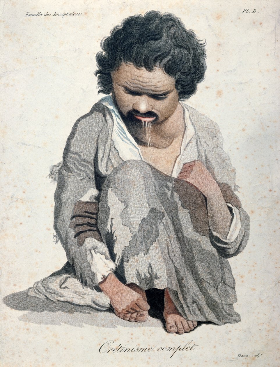Totaler Kretinismus, aus einem Buch von Baron Jean Louis Alibert (1768-1837) von Salvadore Tresca