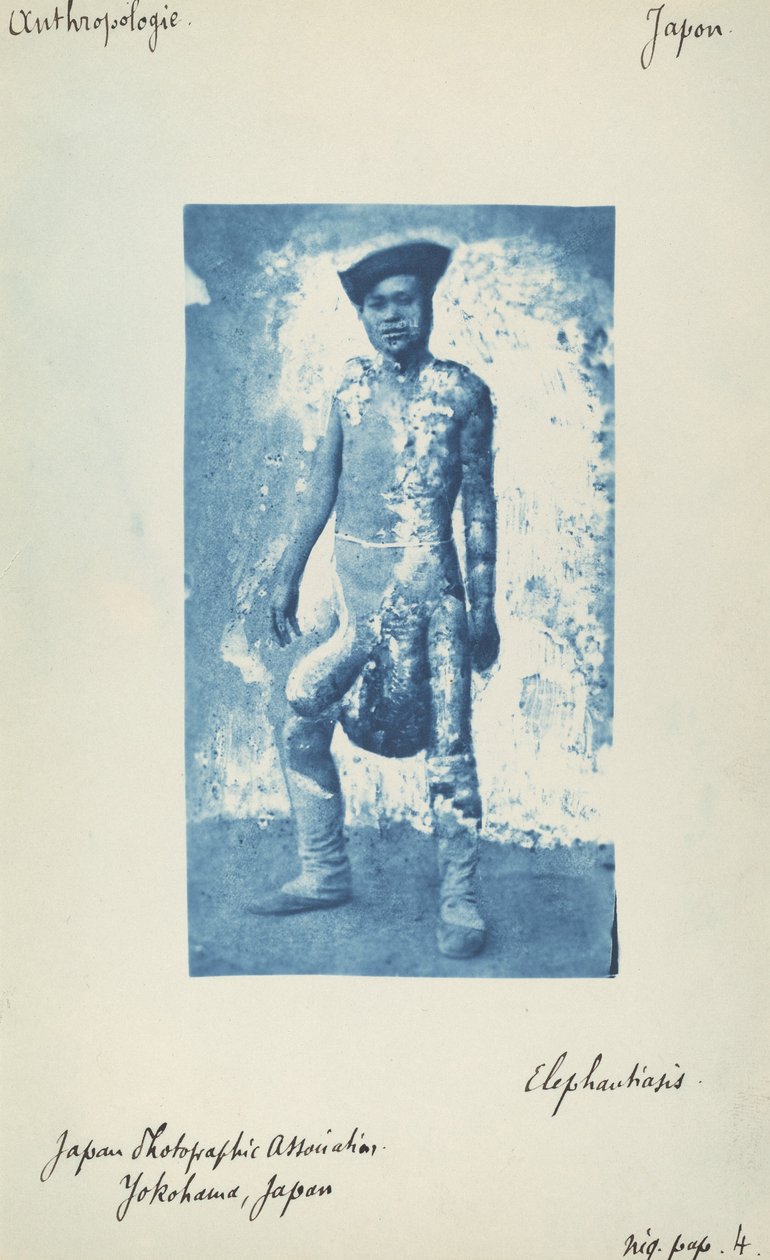 Elephantiasis von Unknown 19th Century