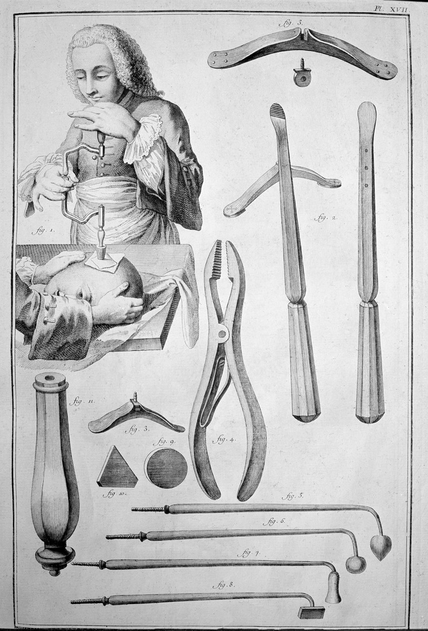 Trepanation des Schädels, verschiedene Instrumente (Gravur) von Unknown artist