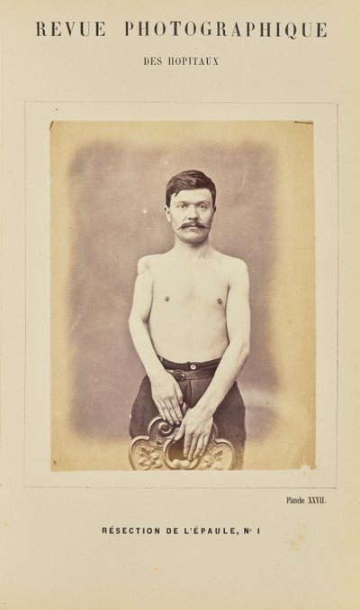 Resektion der Schulter, Nummer 1 von Arthur de Montmeja