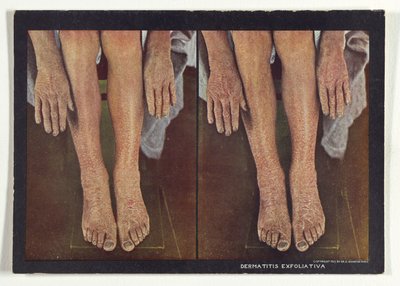 Dermatitis Exfoliativa von Dr. Selden I. Rainforth