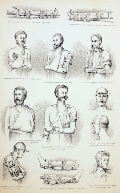 Vorübergehende Behandlung von Frakturen, um 1890 von English School