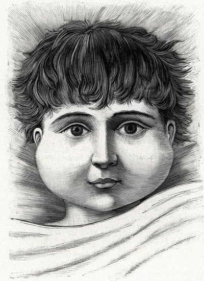Kind mit Mumps (Gravur) 1888 von French School