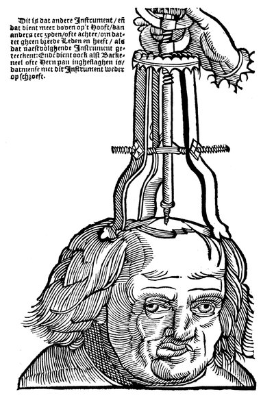 Trepanation, 1593 von Unbekannt
