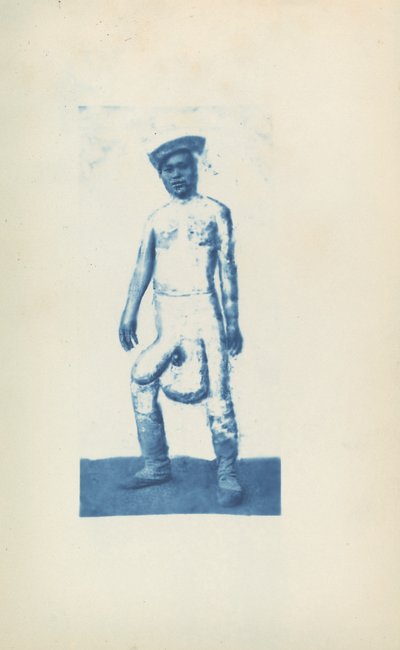 Elephantiasis von Unknown 19th Century